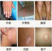 白斑早期症状图片