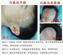 对比白斑图片，解析白癜风症状