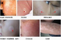 身上这些信号 小心白癜风缠身