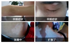 请认真细看!白癜风早期症状图片